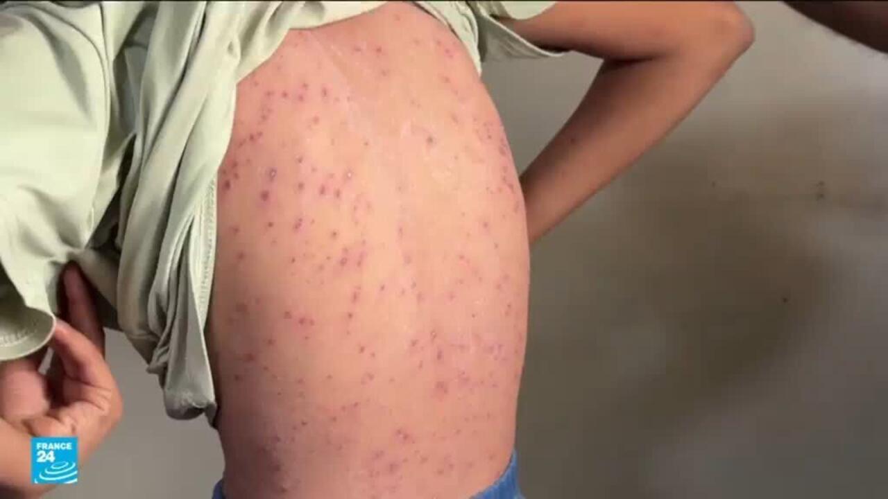 تفشي جدري الماء في غزة: أزمة صحية متفاقمة